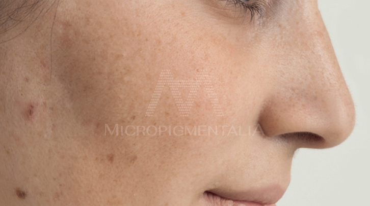 Antes · Antiaging